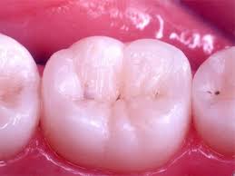 dental-filling-materials