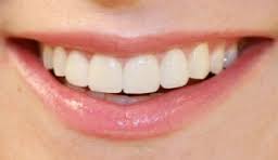 hydrogen-peroxide-teeth-whitening