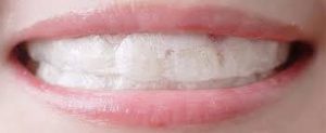 teeth whitening strips