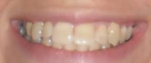 clear braces